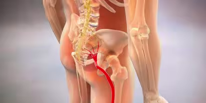 Diagnóstico de la Ciática